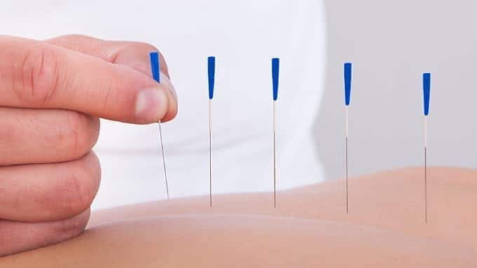 Overcome Infertility With Acupuncture