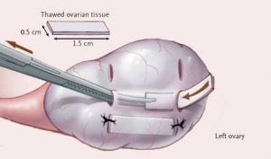 Ovarian Tissue Transplants to Help Conceive After Cancer