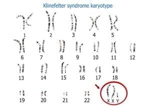 Male Infertility and Klinefelter Syndrome