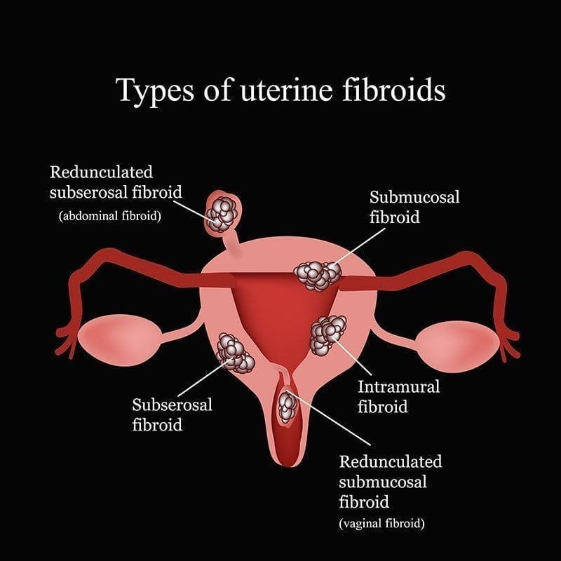 Uterine Fibroids And Their Role On Infertility Fertility Tips 8895