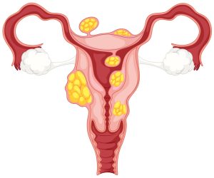 Uterine Factor Infertility: How Abnormalities May Impact Your Fertility 1